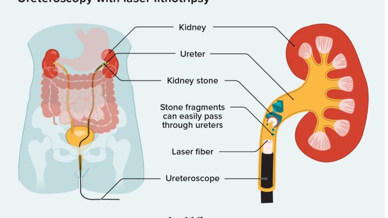 The Top 3 Myths About Kidney Stone Removal Ureteroscopy Debunked