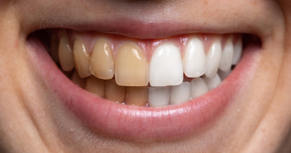 How to Prevent Teeth Staining? 5 Tips to Keep Teeth Staining at Bay